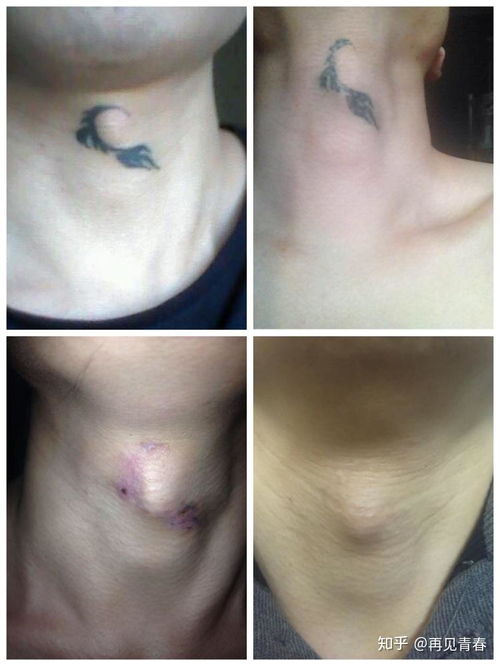 超皮秒洗纹身效果怎么样：超皮秒洗纹身效果怎么样？