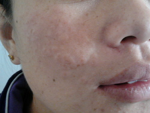 脸上白点癫风的早期图片：警惕！脸上出现这些白点，可能是白癜风早期信号