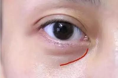 眼袋手术有风险和后遗症吗：眼袋手术，揭开风险与后遗症的真相