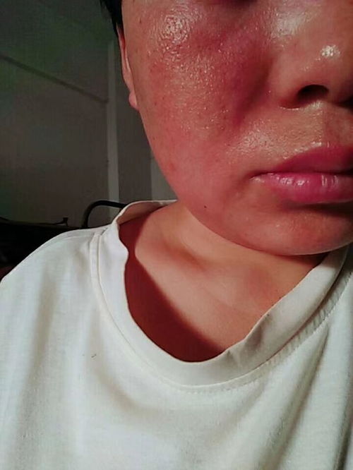 脸部过敏图片：脸部过敏症状，认识与应对