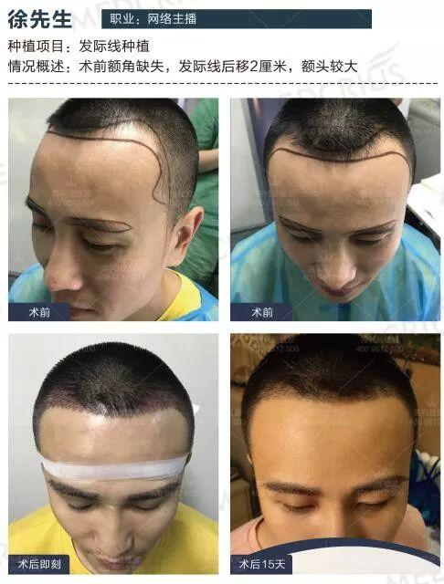 什么季节植发效果最好：什么季节植发效果最好？季节对植发效果的影响解析