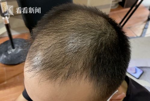 什么季节植发效果最好：什么季节植发效果最好？季节对植发效果的影响解析