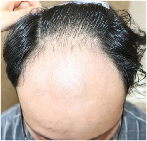 什么季节植发效果最好：什么季节植发效果最好？季节对植发效果的影响解析