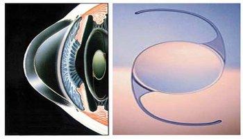 人工晶体植入多少钱:揭秘!人工晶体植入多少钱?全面解析费用构成与影响因素