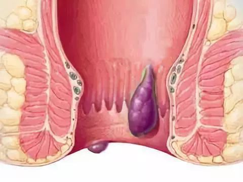 什么药能使痔疮干瘪脱落:痔疮治疗误区,不存在让痔疮干瘪脱落的神奇药物 什么药能使痔疮干瘪脱落:痔疮治疗误区,不存在让痔疮干瘪脱落的神奇药物