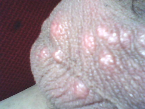 阴囊瘙痒用什么药：阴囊瘙痒用什么药？这些药物和注意事项请收好！