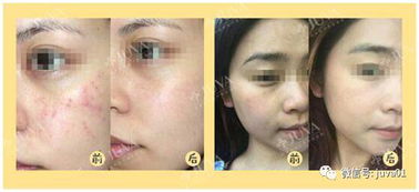 16岁痘痘怎么消除：16岁痘痘怎么消除？青春期痘痘护理全攻略