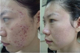 拉皮后脸上有硬块怎么消除：拉皮后脸上有硬块怎么办？这些方法或许能帮到你