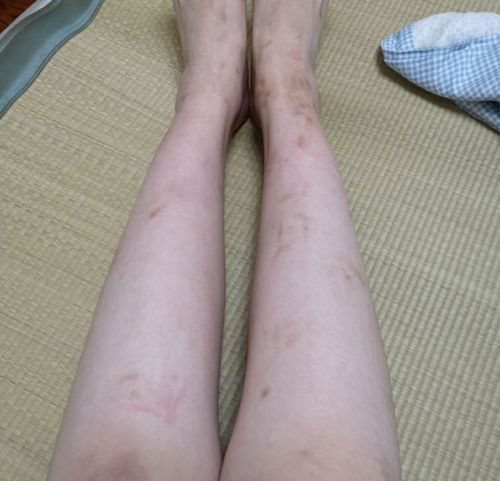 治疗扁平疣的特效药膏：扁平疣的终极解决方案，特效药膏真的存在吗？