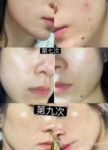 光子嫩肤一次能维持多久：光子嫩肤一次能维持多久？效果持久的关键在这里！