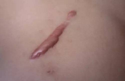 疤痕体质能做近视手术吗：疤痕体质的人能做近视手术吗？