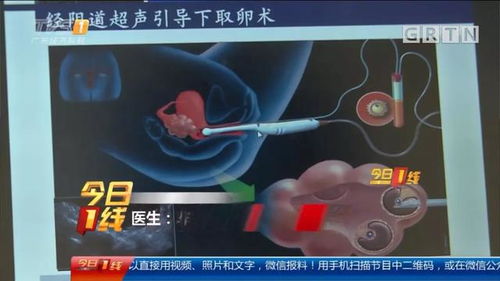 正规医院哪里收卵子：正规医院哪里收卵子？辅助生殖技术供卵机构选择指南