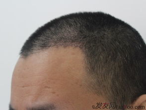 植发最难熬的三个阶段：植发后最难熬的三个阶段，你经历过几个？