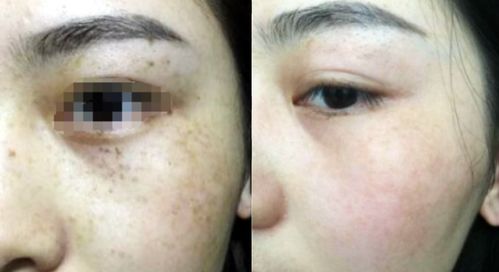 脸上长斑用什么祛斑最好：脸上长斑用什么祛斑最好？科学解析斑点类型与针对性解决方案