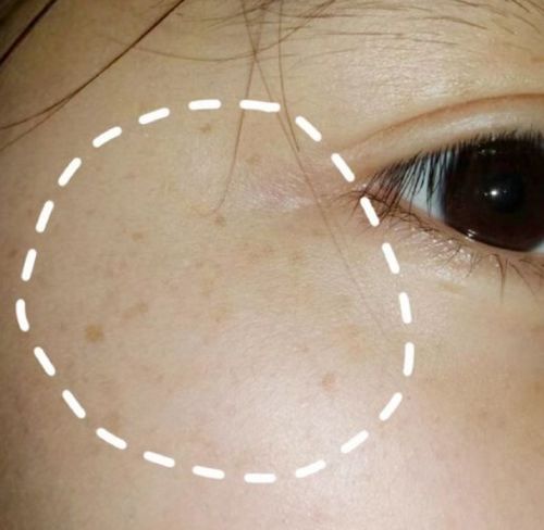 脸上长斑用什么祛斑最好:脸上长斑用什么祛斑最好?科学解析斑点类型与针对性解决方案 脸上长斑用什么祛斑最好:脸上长斑用什么祛斑最好?科学解析斑点类型与针对性解决方案