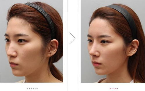 脂肪胶和自体脂肪区别：脂肪胶与自体脂肪，面部填充的两大选择，有何区别？