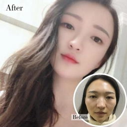 脂肪胶和自体脂肪区别:脂肪胶与自体脂肪,面部填充的两大选择,有何区别? 脂肪胶和自体脂肪区别:脂肪胶与自体脂肪,面部填充的两大选择,有何区别?