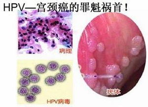 hpv16阳性最佳治疗方案：HPV16阳性最佳治疗方案，专家指导与科学应对策略