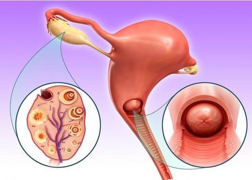 多囊是什么原因造成的：多囊卵巢综合征的成因解析