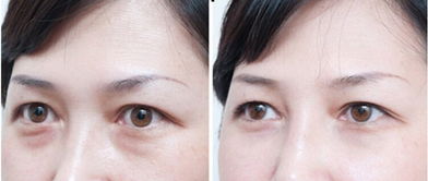 消除眼袋皱纹：彻底告别眼袋与皱纹，自然、有效的双眼焕新指南