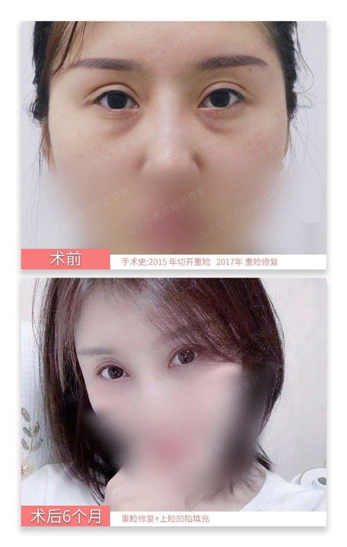 国内顶级修复双眼皮专家：国内顶级修复双眼皮专家是谁？权威名单公布！