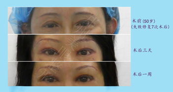 国内顶级修复双眼皮专家：国内顶级修复双眼皮专家是谁？权威名单公布！