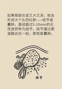 女性肛门褶皱处长了个小疙瘩：健康科普，女性肛门褶皱处长小疙瘩的原因与应对方法