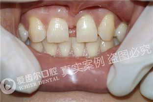 门牙牙缝大修复估计要多少钱：门牙牙缝大修复费用全解析，从方法到价格一文看懂