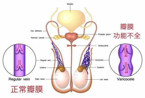 精索静脉曲张的最快消除方法：精索静脉曲张的最快消除方法
