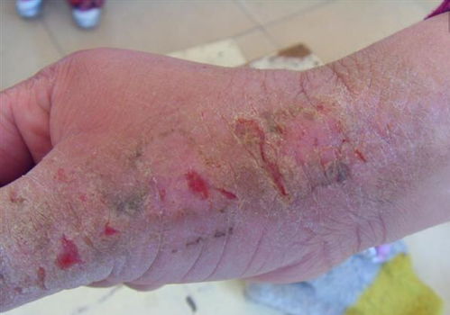 什么药治湿疹痒效果最好：湿疹瘙痒的困扰，什么药治湿疹痒效果最好？