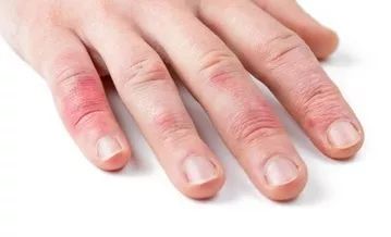 怎么治冻疮简单方法：冬季防冻疮，这几个简单方法轻松搞定