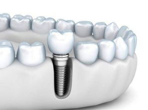 扬州种植牙多少钱一颗牙:扬州种植牙价格参考,从几百到几千不等,详解影响因素与选择技巧 扬州种植牙多少钱一颗牙:扬州种植牙价格参考,从几百到几千不等,详解影响因素与选择技巧