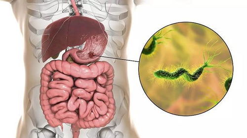 幽门螺杆菌感染阳性多少算严重：幽门螺杆菌感染阳性多少算严重？三分风险、七分解读，医生这么说
