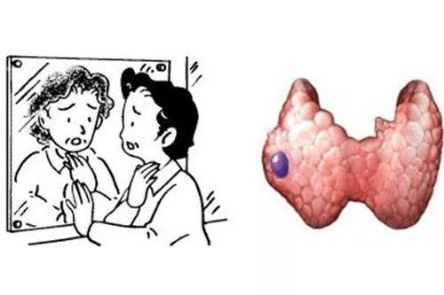 甲减的饮食禁忌大全：甲减患者的饮食禁忌大全，全面解析，助你科学管理甲状腺健康