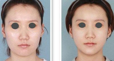 下颌角磨骨手术大概多少钱：下颌角磨骨手术价格详解，影响因素、参考范围与注意事项