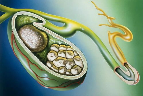 老中医说胆结石最佳治疗方法:老中医揭秘胆结石最佳治疗,中西医结合效果更佳 老中医说胆结石最佳治疗方法:老中医揭秘胆结石最佳治疗,中西医结合效果更佳