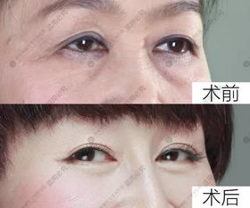 祛眼袋手术:告别小眼睛烦恼!详解祛眼袋手术,原理、方法与注意事项