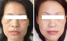 脸部去皱纹多少钱一针:脸部去皱纹多少钱一针?全解析与价格参考!