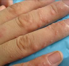 汗疱疹：警惕！这可能是顽固皮肤问题—汗泡疹