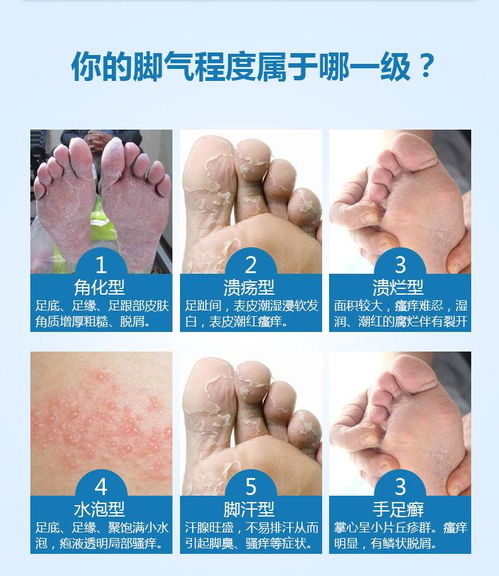 脚痒脱皮起水疱烂脚丫用什么药好：脚痒、脱皮、起水疱、烂脚丫？这些症状可能是足癣（脚气）用什么药好？