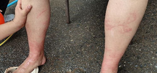 伤到什么程度打破伤风:警惕!这些伤口必须打破伤风