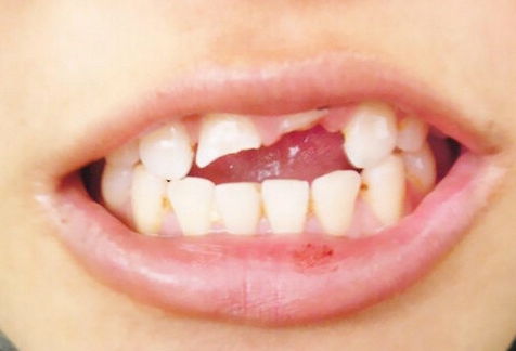 牙齿掉了有什么寓意:牙齿脱落,跨越文化的生命隐喻