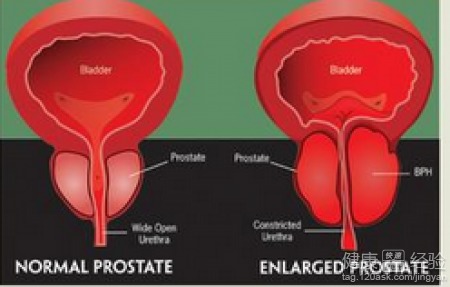 前列腺肥大的症状：前列腺肥大，不容忽视的症状与健康警示