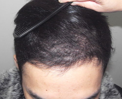 植发3000根毛囊要多少钱：植发3000根毛囊要多少钱？全面解析费用构成与选择技巧