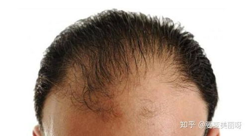 植发3000根毛囊要多少钱:植发3000根毛囊要多少钱?全面解析费用构成与选择技巧 植发3000根毛囊要多少钱:植发3000根毛囊要多少钱?全面解析费用构成与选择技巧