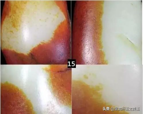 火疖子成熟的图片:火疖子成熟阶段的特征与图片解析,从形成到处理的完整指南