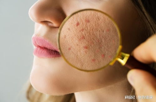 火疖子成熟的图片:火疖子成熟阶段的特征与图片解析,从形成到处理的完整指南 火疖子成熟的图片:火疖子成熟阶段的特征与图片解析,从形成到处理的完整指南