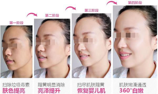 美白针能打吗:美白针能打吗?美容新宠背后的科学与风险 美白针能打吗:美白针能打吗?美容新宠背后的科学与风险