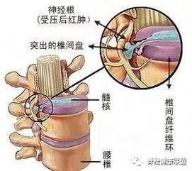 腰椎间盘膨出最好的治疗方法:腰椎间盘膨出的最佳治疗方案,综合评估与个性化选择