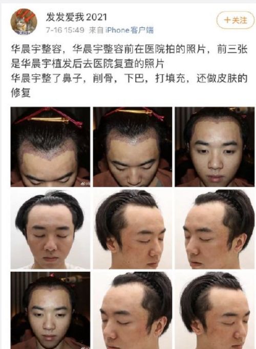 植发后需要禁欲吗:植发后需要禁欲吗?真相在这里! 植发后需要禁欲吗:植发后需要禁欲吗?真相在这里!